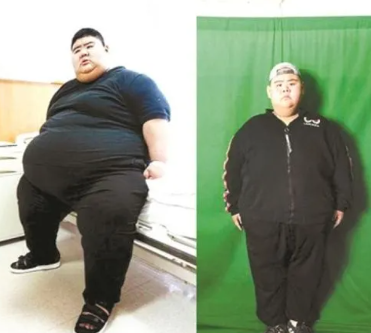 “中国第一胖”成励志哥 术后减284斤二号站